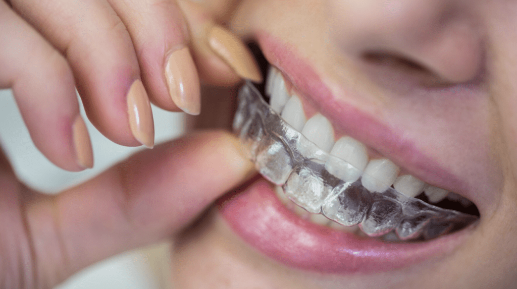 What Are The Benefits of Invisalign?